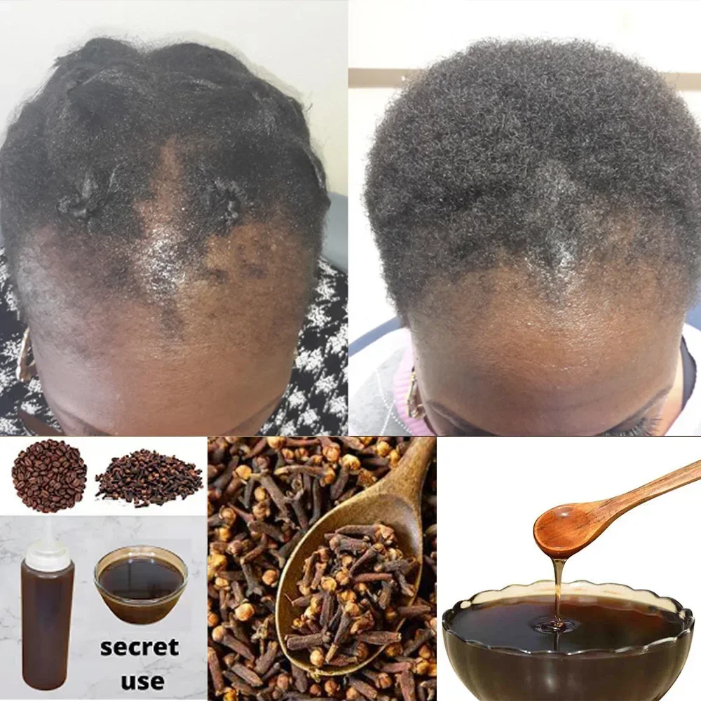 Hair Care Ginseng - Afrika Vrouwen Tractie Alopecia Behandeling Haaruitval