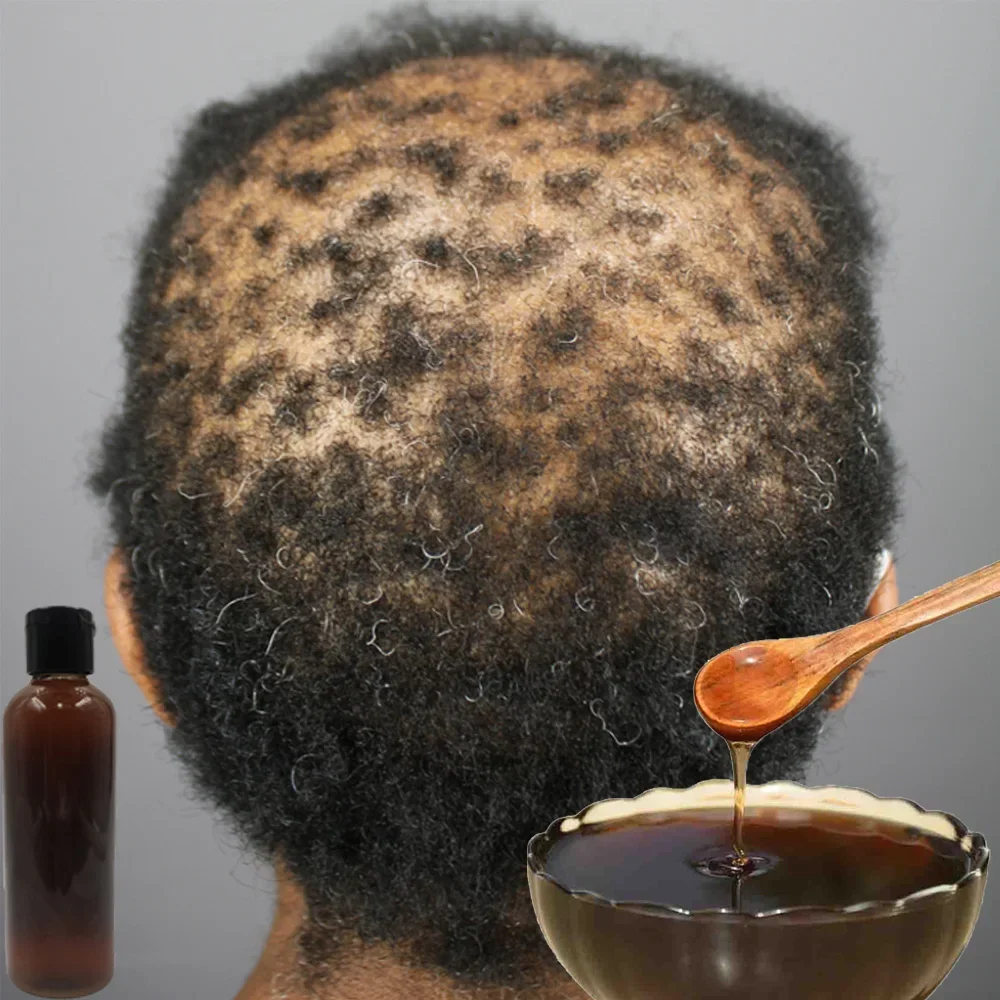 Afrika Vrouwen Tractie Alopeci - Hair Care Ginseng recensie en prijs